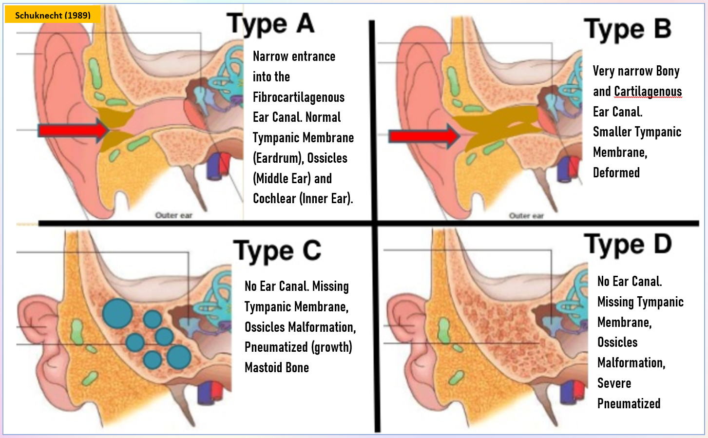 what-is-microtia-atresia-malaysia